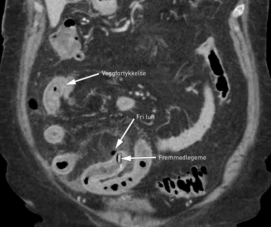 Figur 1  CT-abdomen viser perforasjon av tynntarm ved fremmedlegemet (tablett i blisterpakning) samt veggfortykkelse/&oslash;dem i&hellip;