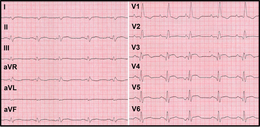 Figur 1  EKG ved innleggelse viste sinustakykardi, supraventrikul&aelig;re ekstrasystoler, inkomplett h&oslash;yre grenblokk, h&oslash;yre akse,&hellip;