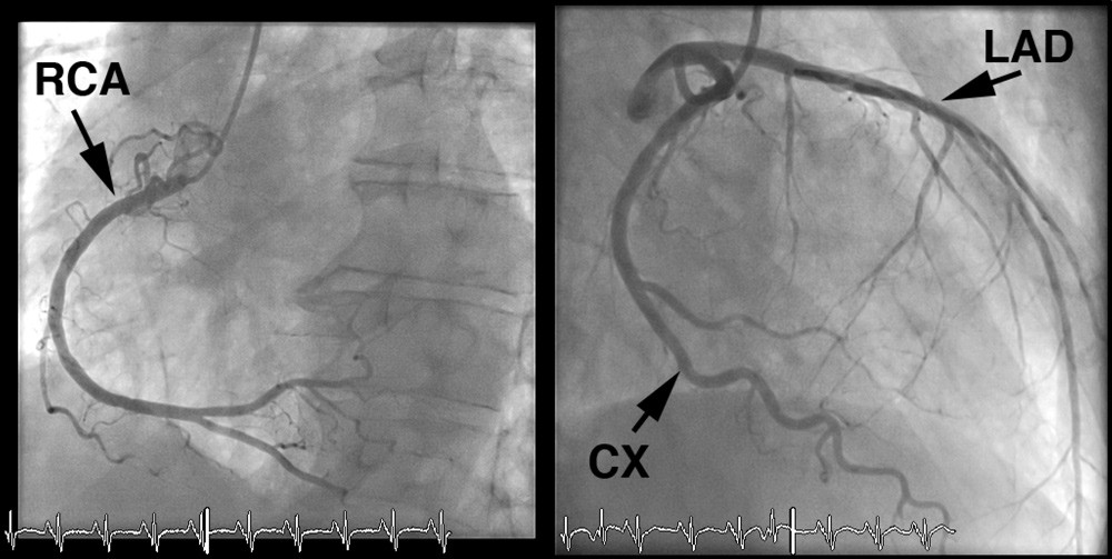 Figur 2  Koronar angiografi. B&aring;de h&oslash;yre og venstre koronararterie hadde veggforandringer, men ingen signifikante stenoser&hellip;