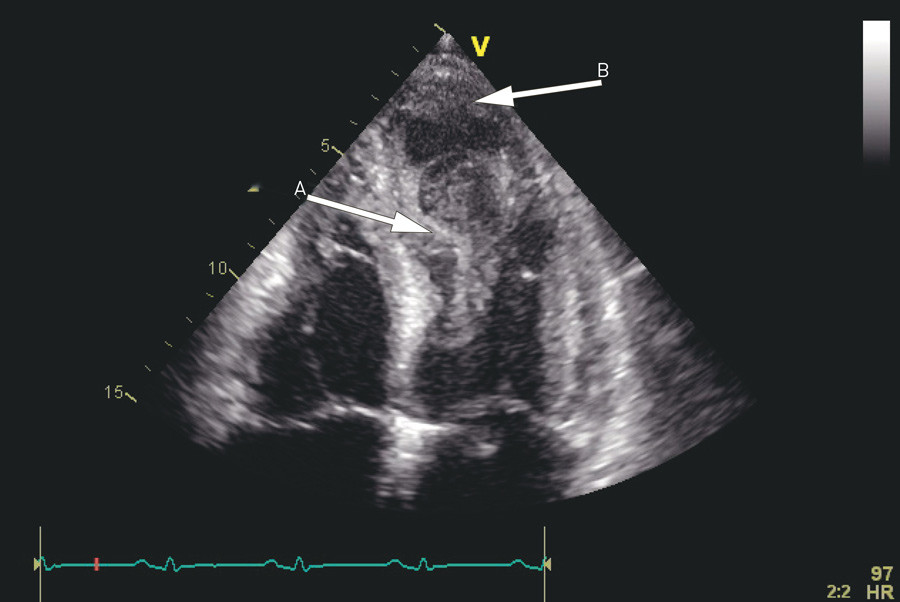 Figur 3  Ekkokardiografisk firekammerbilde av venstre ventrikkel. Venstre ventrikkel-funksjonen var alvorlig redusert. Det&hellip;
