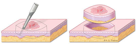Figur 1  Skisse av korrekt utf&oslash;rt eksisjon av hudlesjon