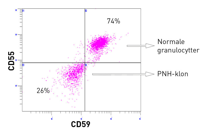 Figur 1  Eksempel p&aring; v&aelig;skestr&oslash;mscytometrisk analyse. Granulocytter som verken uttrykker CD59 eller CD55 utgj&oslash;r PNH-klonen,&hellip;