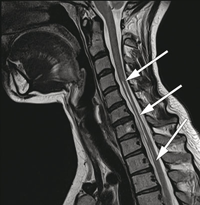 Figur 3  Sagittal T2-vektet cervikal MR med atrofi av medulla fra C6 til Th2 og h&oslash;ysignallesjon fra C4 til Th2