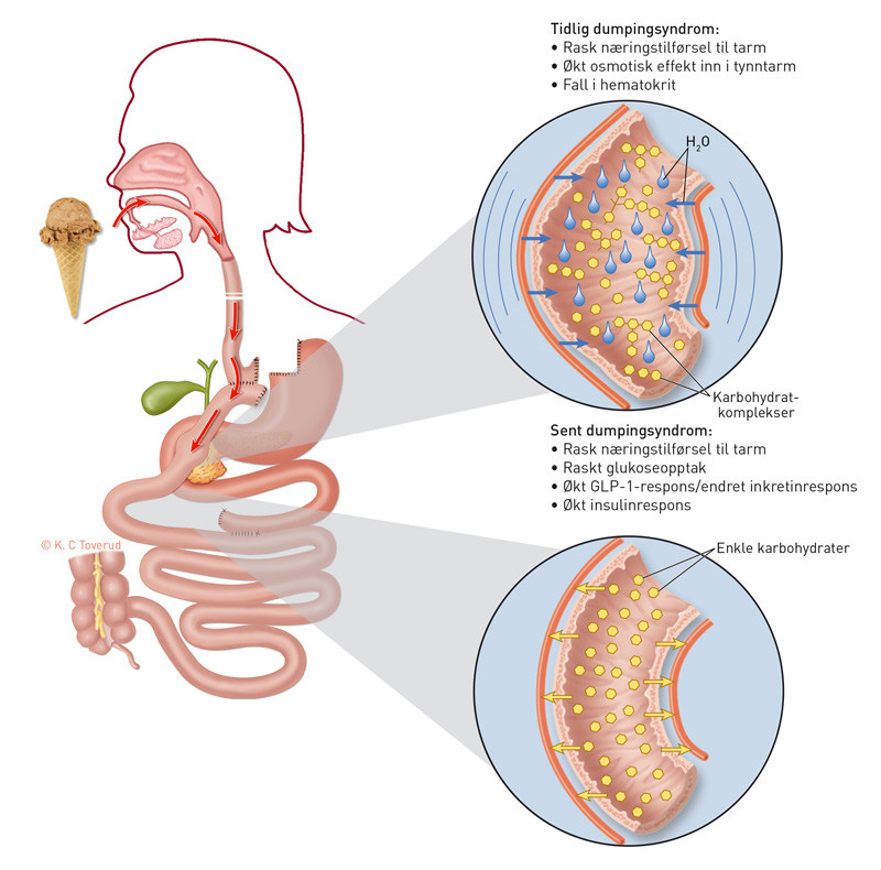 Figur 1  Skjematisk fremstilling av dumpingsyndrom etter gastrisk bypass. Den r&oslash;de pilen indikerer hurtig passasje av n&aelig;ring&hellip;
