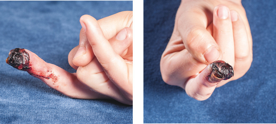 Figur 1  Ved ankomst universitetssykehuset, omtrent fire m&aring;neder etter symptomdebut, s&aring; fingeren slik ut. Foto: &Oslash;ystein H&hellip;