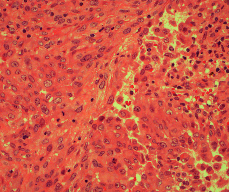 Figur 4  Mikroskopisk unders&oslash;kelse viser spolformede celler med runde eller ovale kjerner med tydelig kjernemembran og&hellip;
