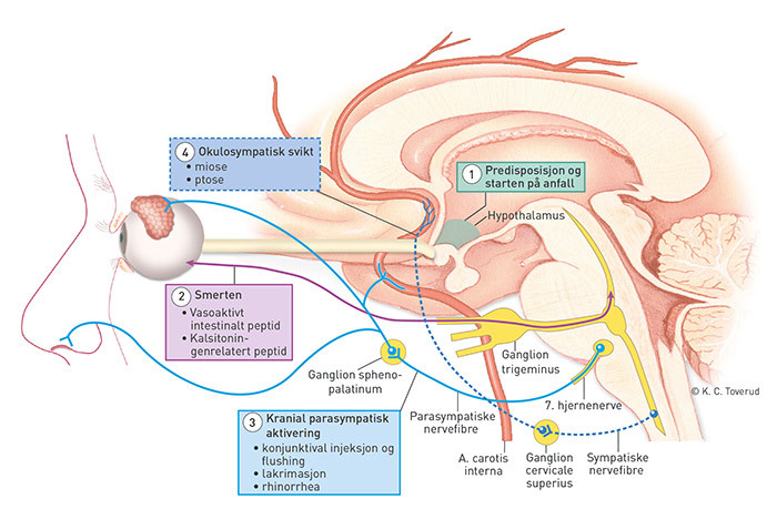 Figur 2  Postulert patofysiologisk mekanisme. &Aring;rsaken til klasehodepine er ukjent, og mekanismene som for&aring;rsaker symptomer&hellip;