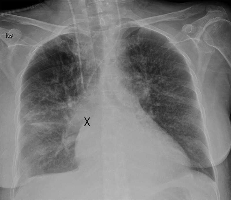 Figur 1  R&oslash;ntgenbilde som viser posisjon av sentralt venekateter nr. 2 og nr. 3. Posisjon av spissen p&aring; nr. 1 (fra tidligere&hellip;