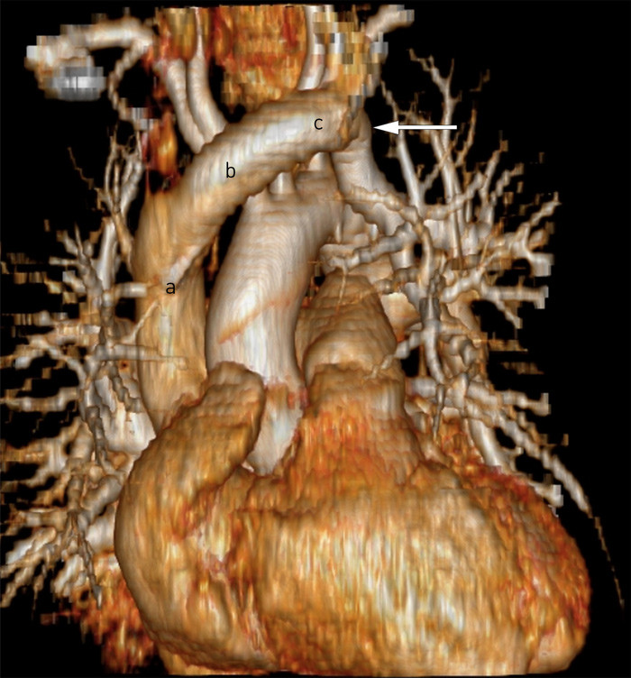 Figure 2  Model of the heart and major vessels of the patient, reconstructed from CT angiography. The point at which a&hellip;