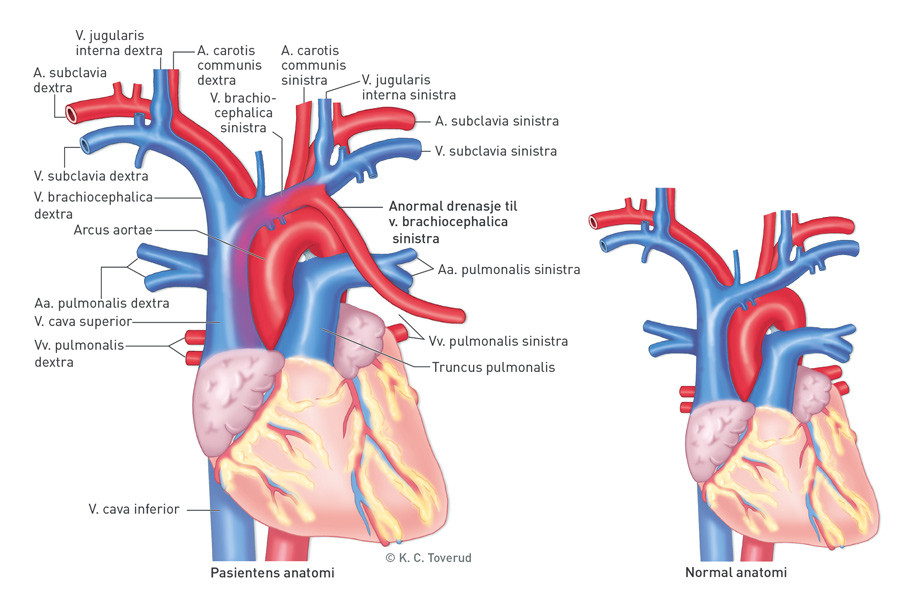 Figur 3  Normal anatomi og pasientens anatomi