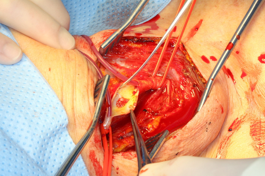 Carotiskirurgi. Foto: K. Krohg-S&oslash;rensen