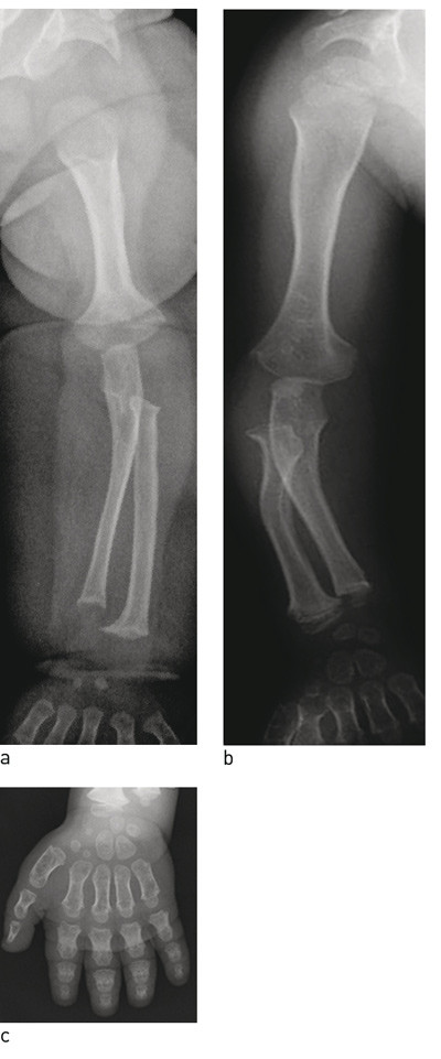 Figur 1  Forkorting av a) overarm/l&aring;r kalles rhizomelisk, forkorting av b) underarm/legg kalles mesomelisk og forkorting av&hellip;