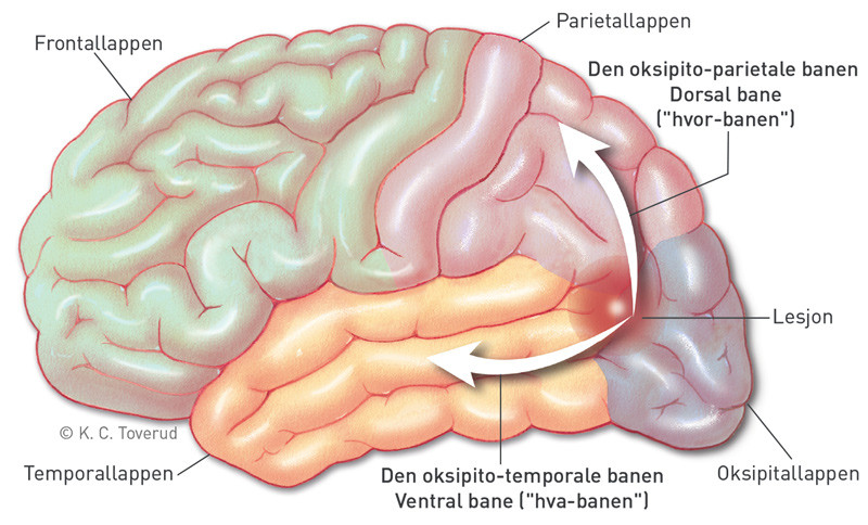 Figur 2  Den oksipito-parietale banen formidler spatial informasjon (dorsal bane, ogs&aring; kjent som &laquo;hvor-banen&raquo;). Den oksipito&hellip;