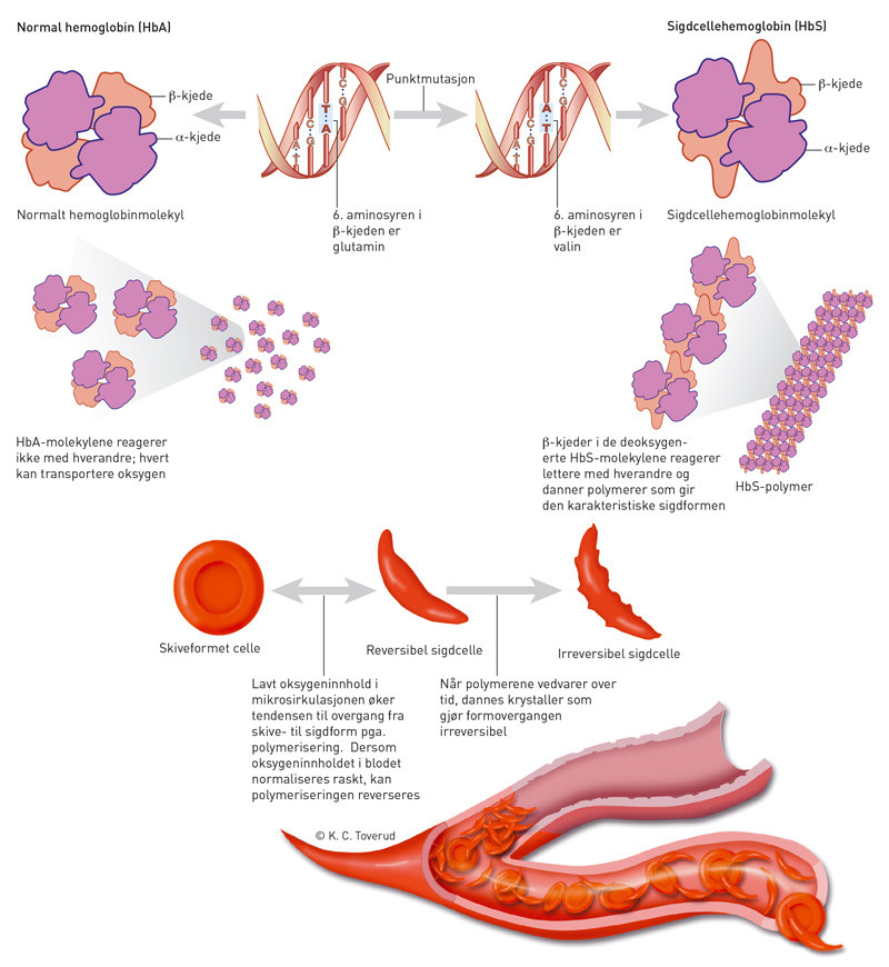 Figur 2  Patofysiologi ved sigdcelleanemi