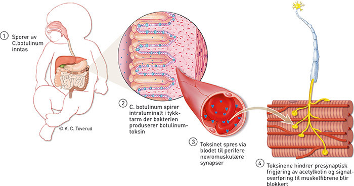 Figur 1  Patogenese ved spedbarnsbotulisme