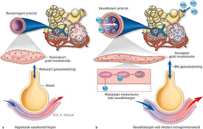 Figur 1  Virkning av inhalert nitrogenmonoksid (iNO) ved hypoksisk vasokonstriksjon. a) hypoksisk vasokonstriksjon, b)&hellip;