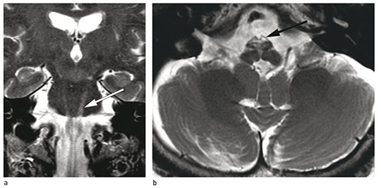 Figur 1  MR-unders&oslash;kelse av pasientens hjerne, tatt ved 70 &aring;rs alder. T2-vektede bilder. Forandringene er asymmetriske og&hellip;