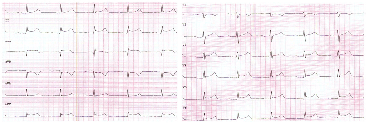 Figur 1  EKG tatt p&aring; universitetssykehus viser oppad konkave ST-elevasjoner i II, III, aVF og V4&thinsp;&ndash;&thinsp;V6