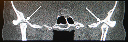 Figur 3  Computertomografi (CT) av kjeveledd. Uttalte degenerative forandringer i begge kjeveledd. Venstre kondyl er&hellip;