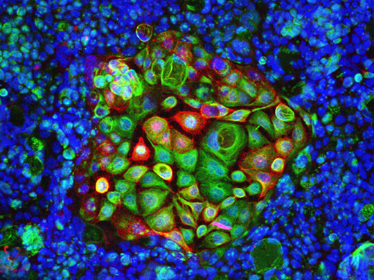 Kolorektalkreftceller. Illustrasjonsfoto: Science Photo Library 