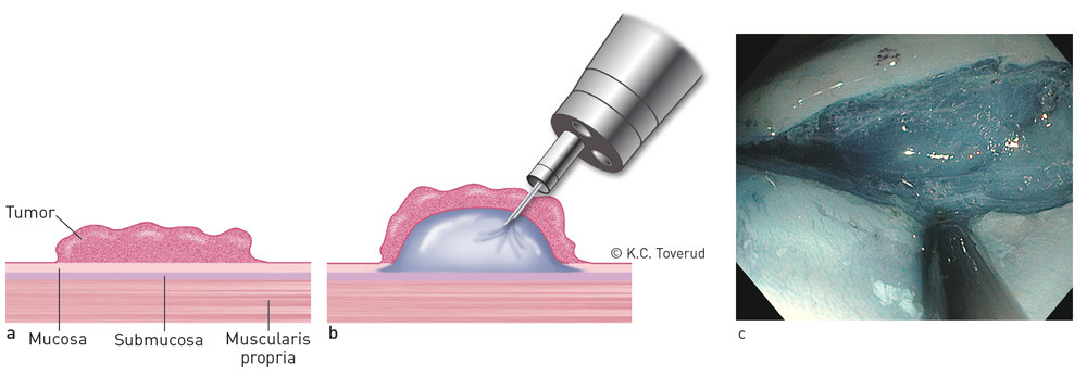 Figur 1  Submukosalt l&oslash;ft skapes ved &aring; injisere en v&aelig;ske (her tilsatt bl&aring;farge) i det submukosale sjiktet mellom muscularis&hellip;