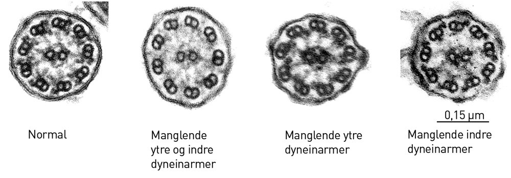 Figur 2  Bilder fra transmisjonselektronmikroskopi, etter Leigh og medarbeidere (11). Gjengitt med tillatelse fra Nature&hellip;