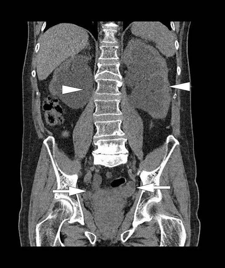 Figur 1  CT urinveier uten kontrast. Frontal projeksjon som viser massiv bilateral hydronefrose og bilateral hydroureter &hellip;