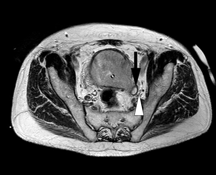 Figur 3  MR bekken (T2-vektet) i aksial projeksjon som viser bl&aelig;retumor med gjennombrudd av bl&aelig;rens muscularis propria som&hellip;