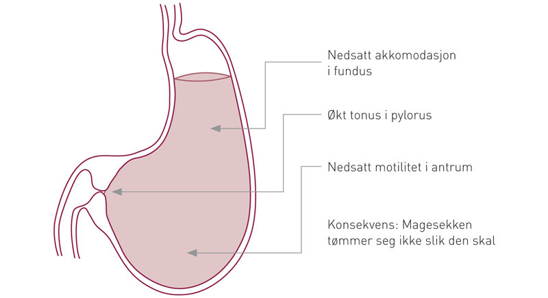 Figur 1  Ved gastroparese kan man blant annet finne nedsatt akkomodasjonsevne i fundus, redusert motilitet i antrum og &oslash;kt&hellip;
