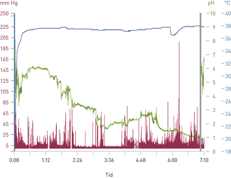 Figur 4  Illustrasjonen viser resultat med tr&aring;dl&oslash;s motilitetskapsel hos samme pasient som i figur 3. Vi ser at pH (gr&oslash;nn&hellip;