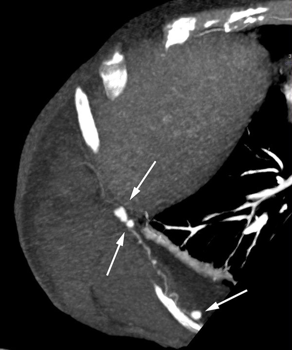 Figur 1  CT-fremstilling av 9. interkostalarterie p&aring; h&oslash;yre side med flere aneurismer og bl&oslash;dning i thoraxveggen. Aneurismene&hellip;