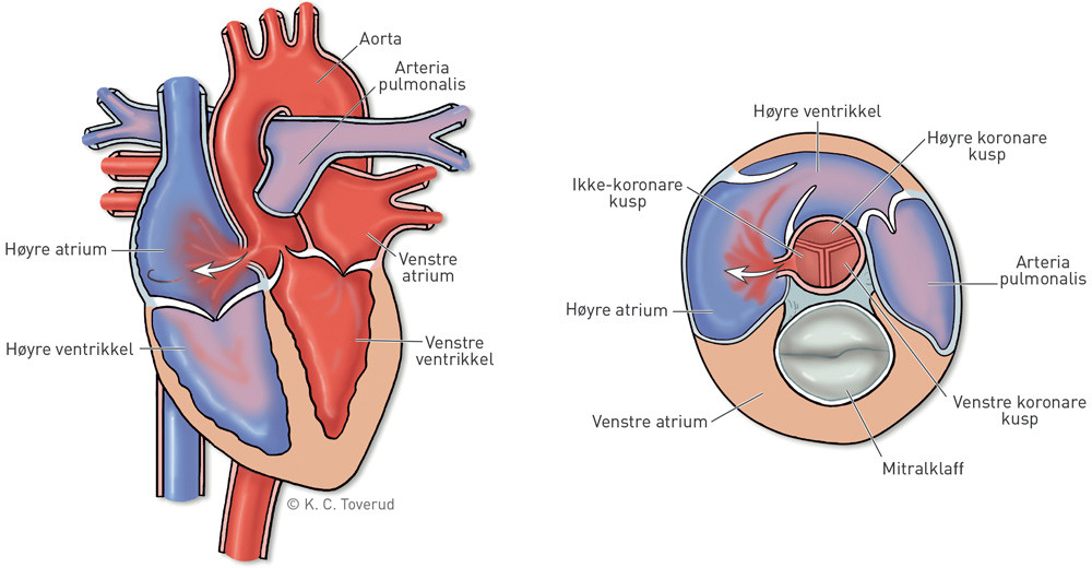Figur 2  Fremstilling av sinus valsalvae-aneurisme med ruptur fra aortaroten til h&oslash;yre atrium. Tverrsnitt til h&oslash;yre