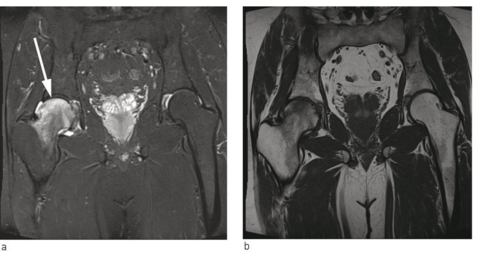 Figur 1  Diffust benmargs&oslash;dem i h&oslash;yre caput og collum femoris &ndash; a) STIR-sekvens, b) T1-sekvens
