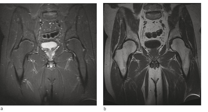 Figur 2  Normalt funn &ndash; a) STIR-sekvens, b) T1-sekvens