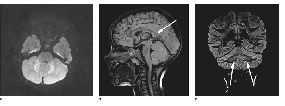 Figur 1  a) Aksial diffusjonsvektet sekvens (B = 1 000) viser redusert diffusjon i omr&aring;det svarende til nucleus dentatus&hellip;