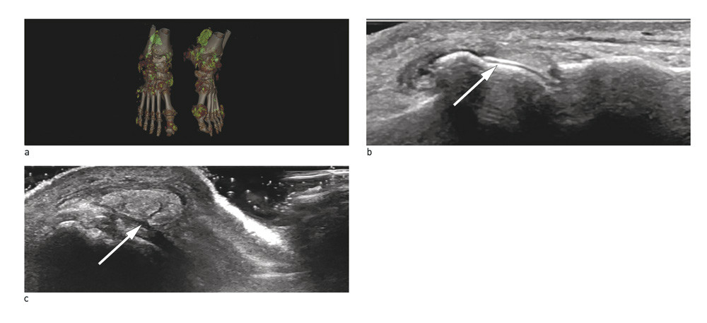 Figur 1  a) DECT-unders&oslash;kelse som viser uratavleiringer i ankler og f&oslash;tter samt langs akillessener. b) Ultralydbilde av&hellip;