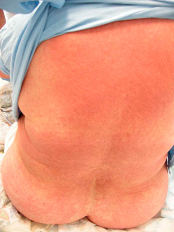 Figur 1  Ved innkomst hadde pasienten et utbredt erytemat&oslash;st makul&oslash;st utslett. Bildet viser rygg, de &oslash;vrige hudomr&aring;der hadde&hellip;