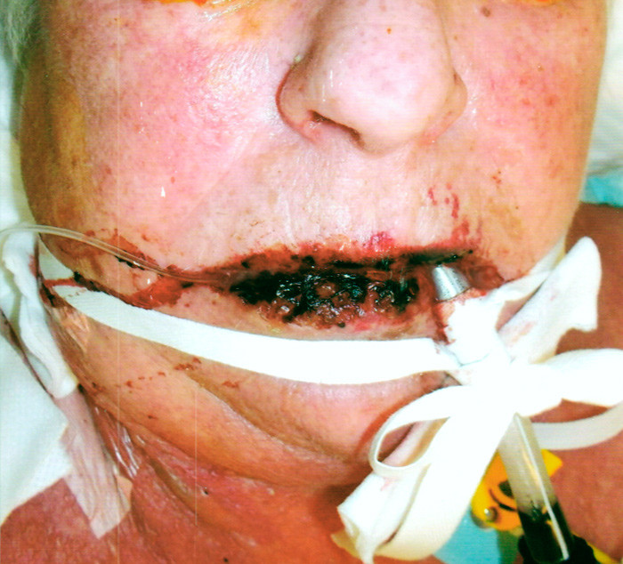 Figur 3  Det utviklet seg uttalt keilitt med erosjoner og kruster. For &oslash;vrig var det utbredte sammenflytende erytemer og&hellip;