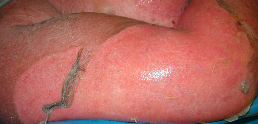 Figur 4  P&aring; dag 7 etter innleggelsen ble det ansl&aring;tt at 90 % av hudoverflaten var dekket av blemmer og erosjoner. Her et&hellip;