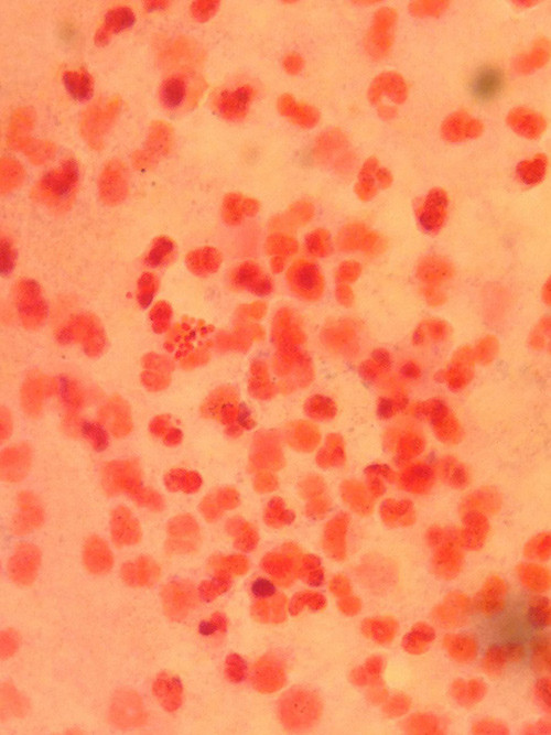 Figur 2  Mikroskopifunn. Grampreparat som viser gramnegative diplokokker funnet ved punksjon av h&oslash;yre ankel