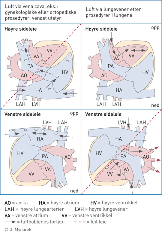 Skjemaet viser hvilket leie som er hensiktsmessig etter luftemboli via hhv. de store hulvenene eller lungevenene. Det er&hellip;