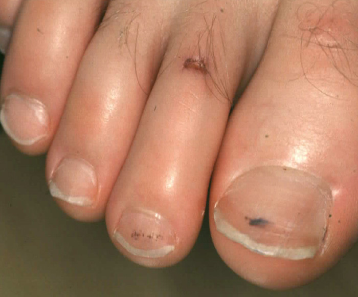 Figur 2  Splinterbl&oslash;dning (neglebl&oslash;dning)