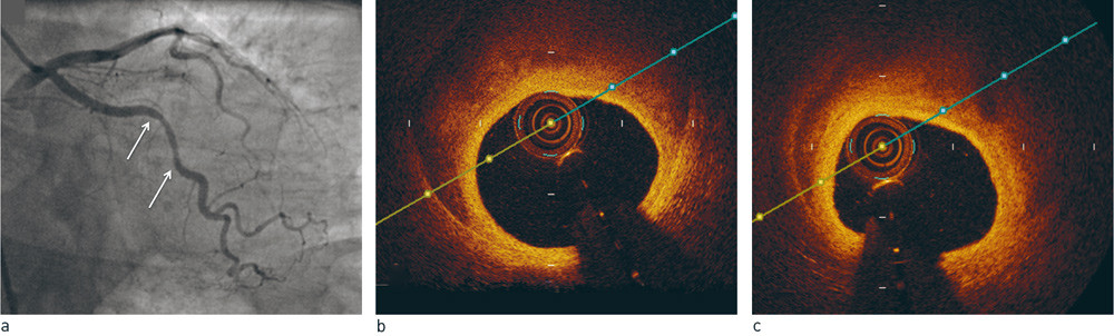Figur 1  Spontan koronar arteriedisseksjon type 3. a) Moderat stenose av midtre ramus cirkumflexus-arterie (mellom piler) p&aring;&hellip;