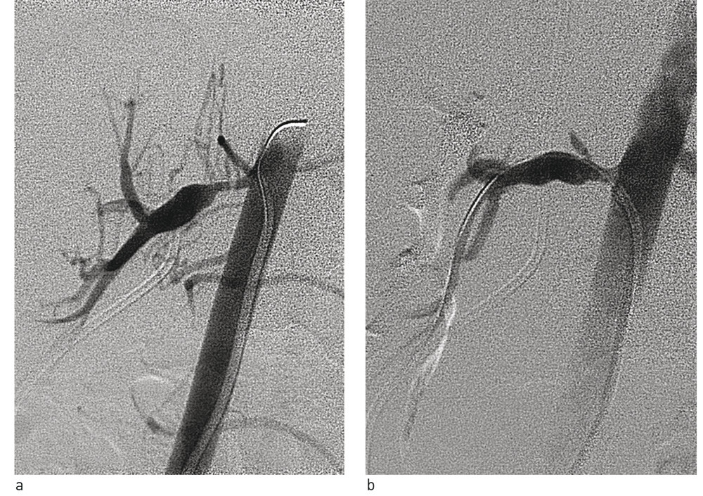 Figur 1  a) Avgangsstenose ved h&oslash;yre nyrearterie. Det foreligger en markert poststenostisk dilatasjon av arterien like etter&hellip;