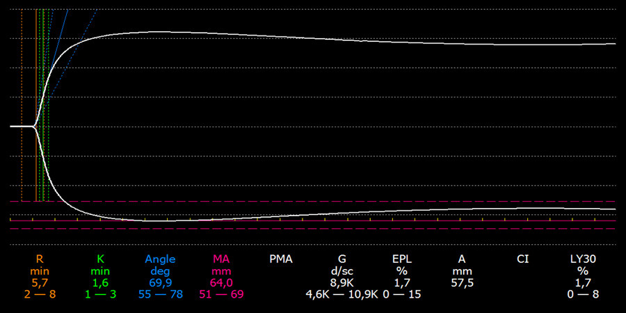 Figur 3  Eksempel p&aring; hvordan en normal kurve kan se ut. Alle variablene ligger innenfor referanseomr&aring;det. Disse vises under&hellip;