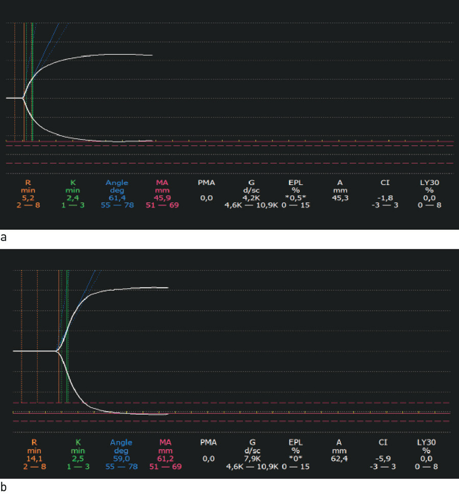 Figur 4  a) Platedysfunksjon. MA-verdien er p&aring; 45,9 mm, som er lavere enn referanseomr&aring;det (51&thinsp;&ndash;&thinsp;69 mm). Alfavinkelen p&aring; 61&hellip;