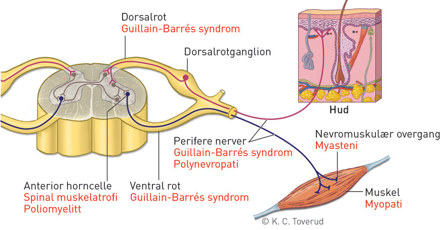 Figur 1  Forenklet fremstilling av lumbale ryggmargsstrukturer (svart) og tilh&oslash;rende nevromuskul&aelig;re sykdomsbilder (r&oslash;dt)