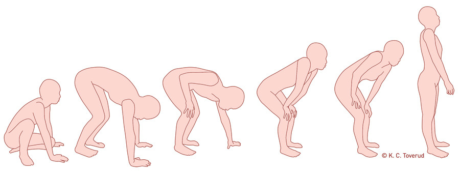 Figur 2  Gowers&rsquo; tegn demonstrerer hvordan en person reiser seg n&aring;r det er svak kraft i proksimal muskulatur i&hellip;