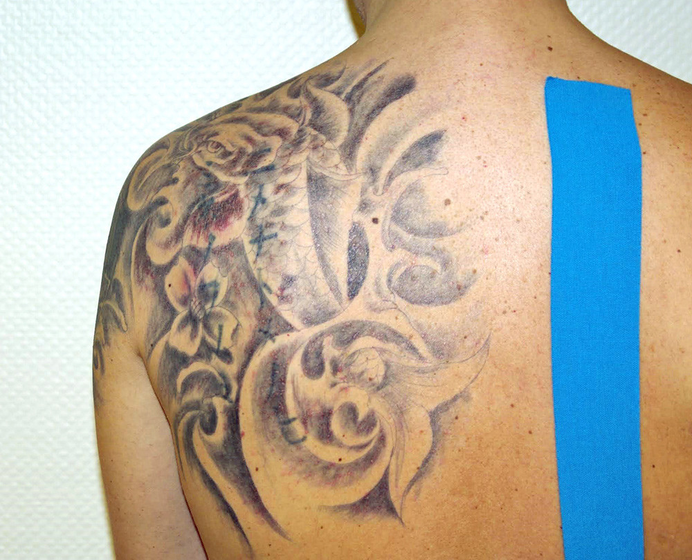 Figur 1  Bildet er tatt ved innleggelsen og viser utslettet med erytemat&oslash;se papler, sm&aring; kruster og pustler svarende til&hellip;