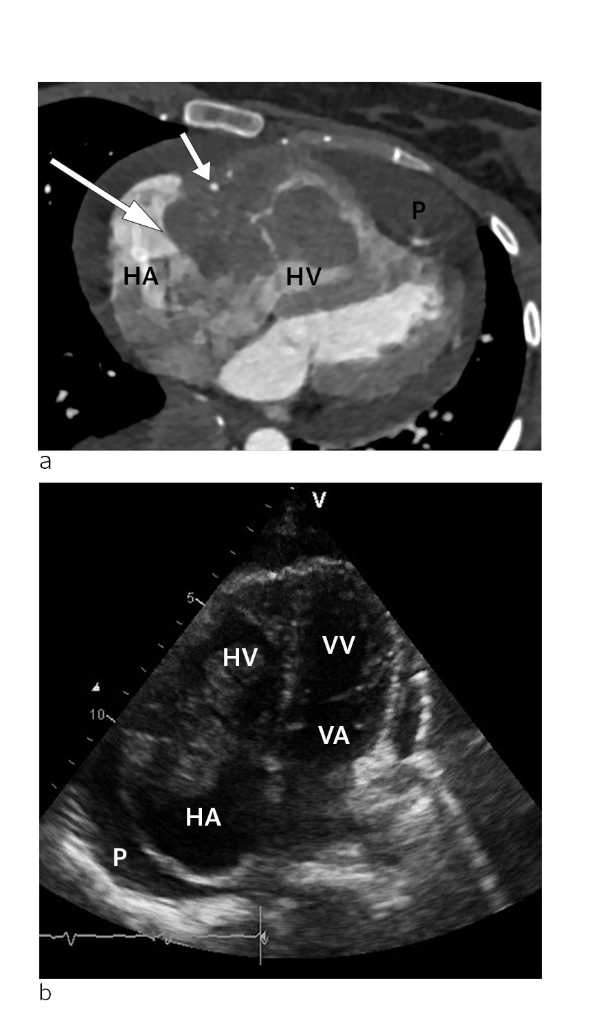 Figur 1 a) CT-unders&oslash;king av hjartet i transversalplan ved diagnosetidspunkt. Tumor (stor pil) i atrioventrikul&aelig;rfura p&aring;&hellip;